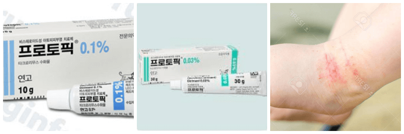 프로토픽 연고, 아토피 피부 사진