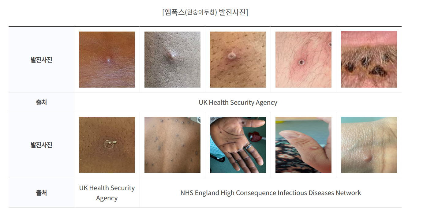 엠폭스-발진-사진