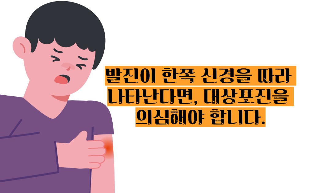대상포진 초기증상