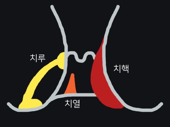 치질 (치핵, 치루) 증상, 원인과 치료
