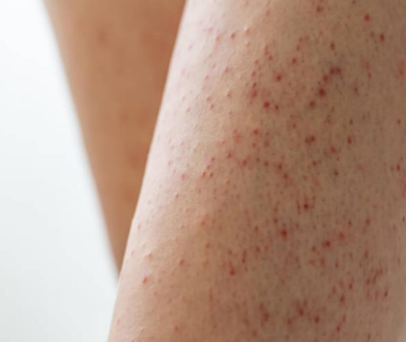 모공각화증 피부 증상