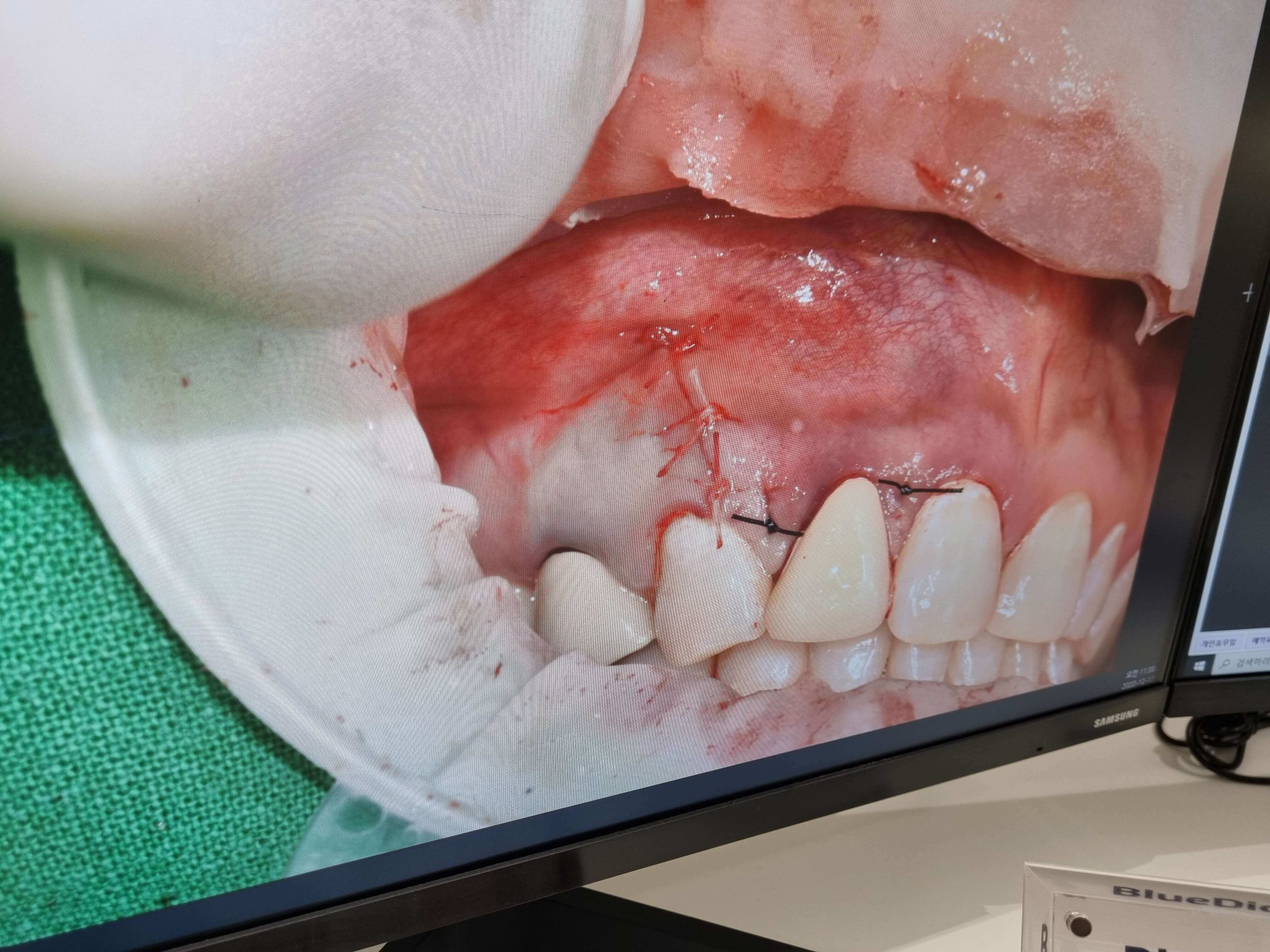 치근단절제술 비용