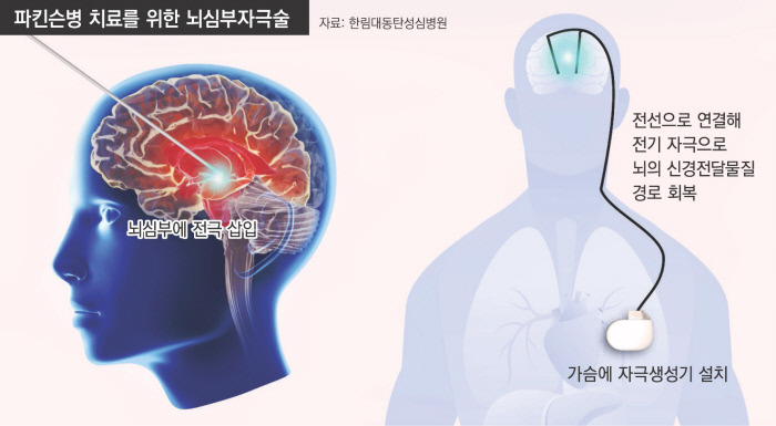 뇌심부자극술-수술-비용-산정특례-적용-기준-(+-밧데리-교체-시기-비용)
