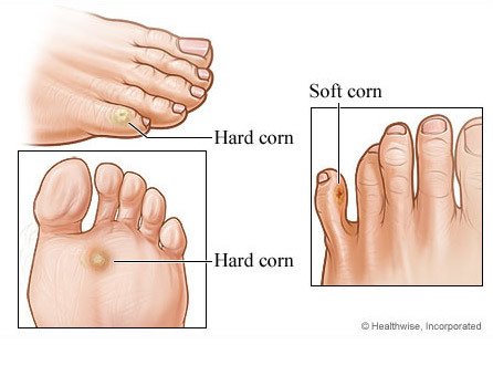 발바닥-티눈-제거-없애는법