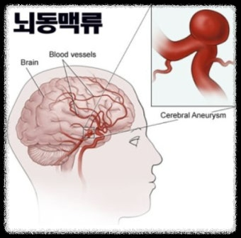 겨울철 필수 건강점검, 뇌동맥류