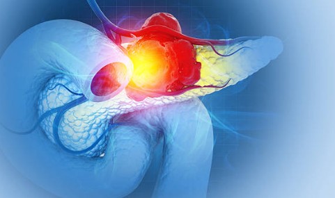 췌장암 초기증상과 예방습관