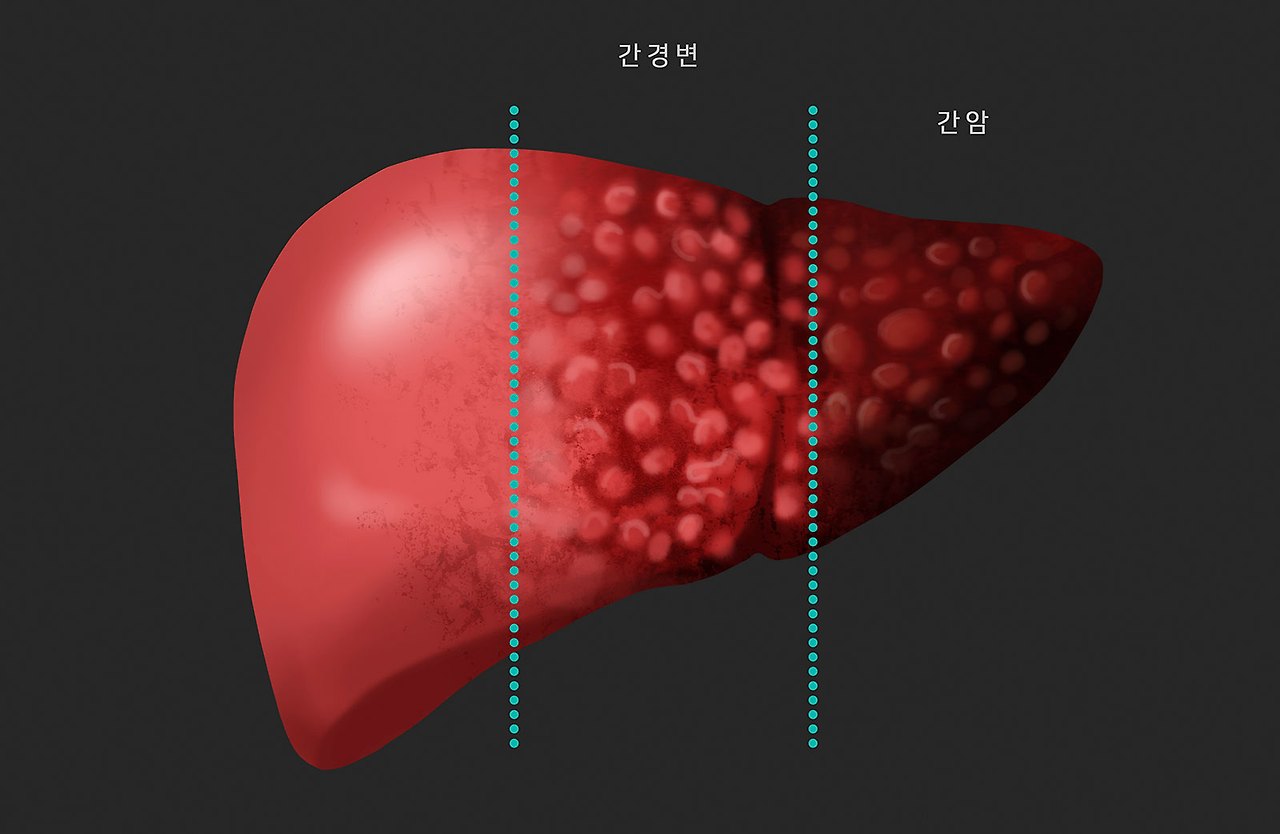 간암 초기증상과 간암 말기증상