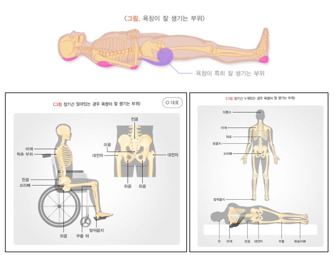 욕창 호발 부위