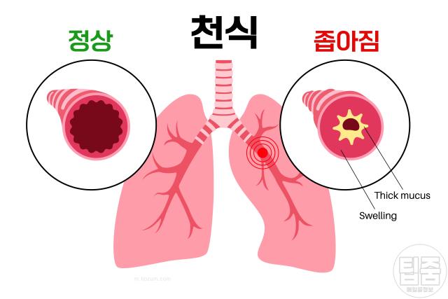 러닝 가슴통증 원인 운동 유발성 천식