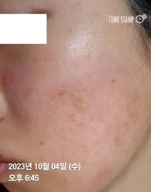 얼굴 피부염