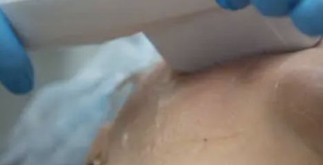 사마귀 제거방법 19