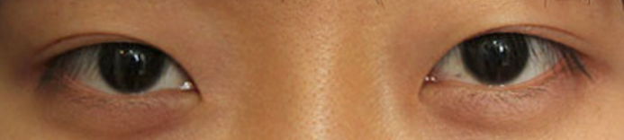 눈매교정 가격 시술대상 주의사항