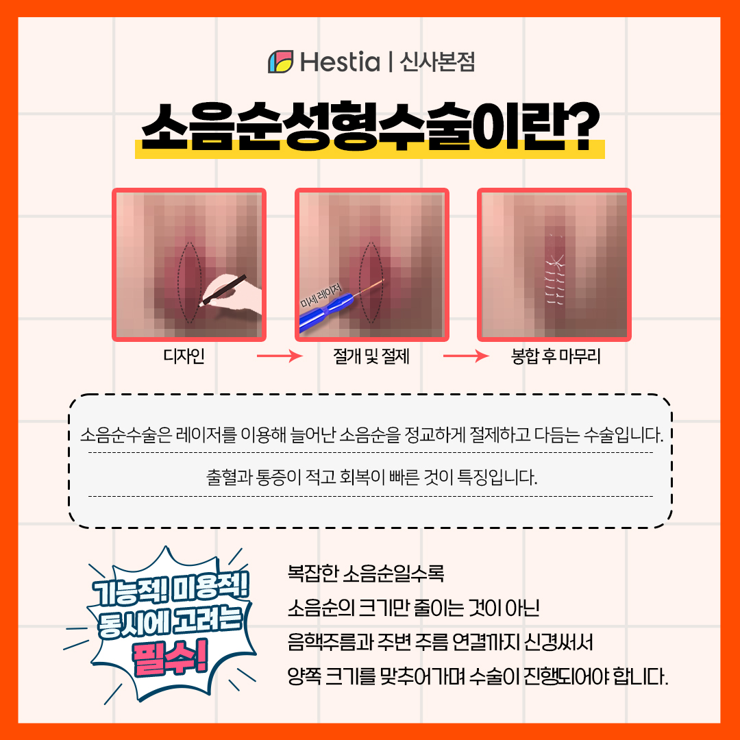 소음순 성형수술이란?
