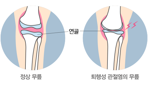 정상 무릎과 퇴행성 관절염의 무릎의 비교