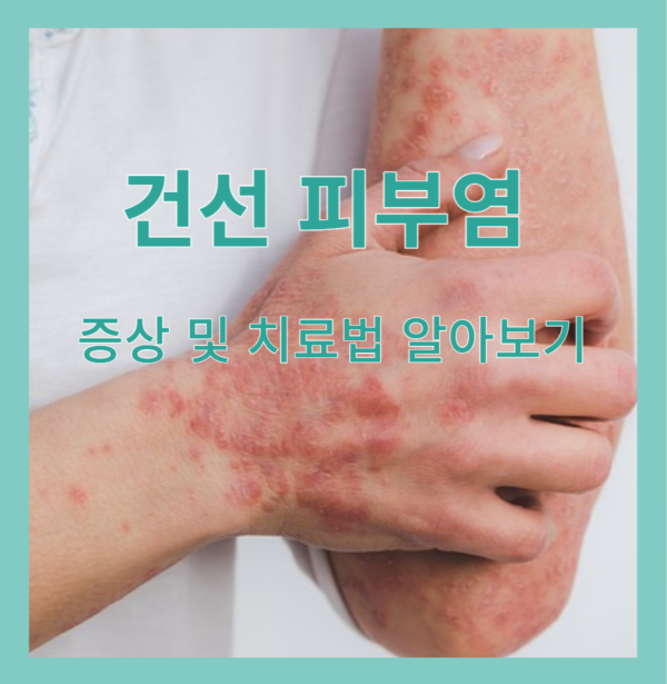 건선 피부염