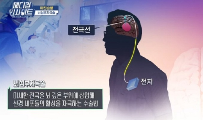 뇌심부자극술-파킨슨