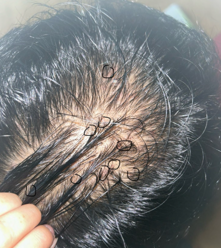 두피 트러블의 원인