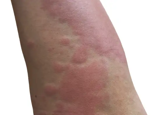 두드러기 원인 및 치료방법