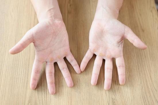 한포진 치료: 증상 완화와 관리 방법