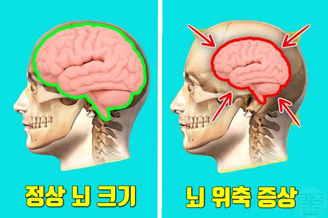 수면부족 증상 뇌위축 잠잘오는법
