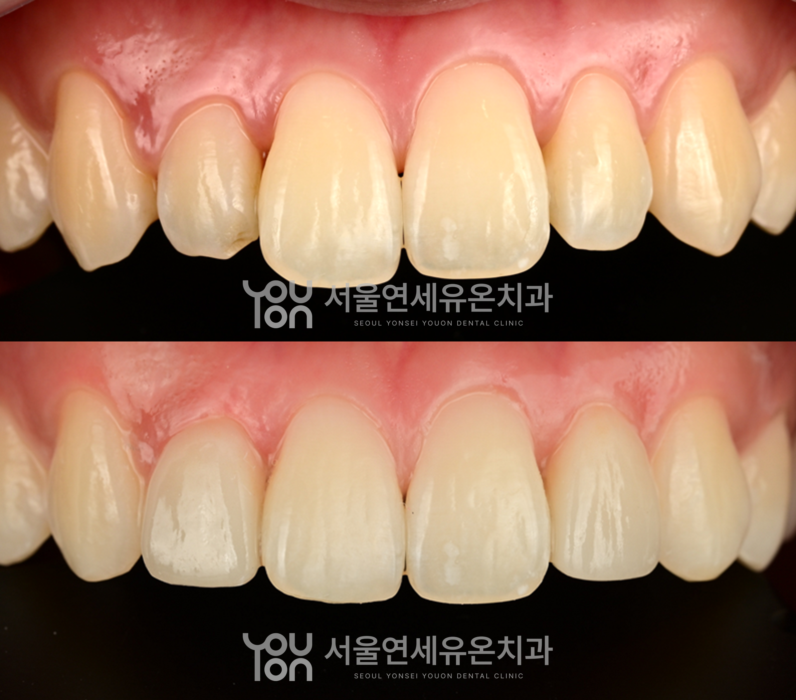 왜소치 라미네이트 치료 전후 비교 - 측절치 크기가 주변 치아와 자연스럽게 조화를 이룬 모습