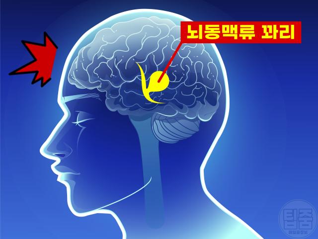 뇌동맥류 증상 경고성 두통