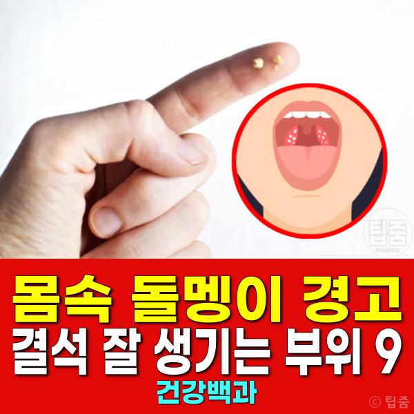 결석 생기는 신체 부위 편도결석