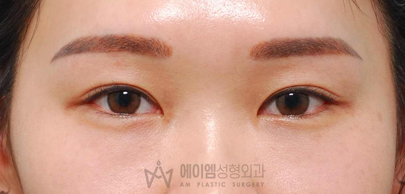 쌍꺼풀 풀림 매몰법 교정 재수술 후 1년5개월
