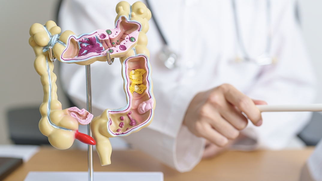 대장 게실염이란?