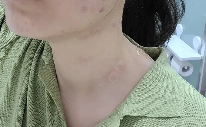 점 제거 후 관리