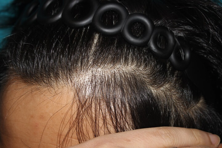 모발이식-생착률