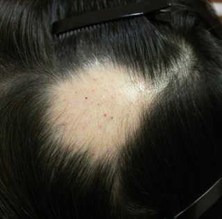 원형탈모의 원인과 치료법