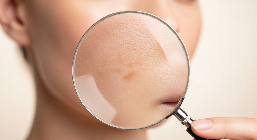 멜라논크림 효과 