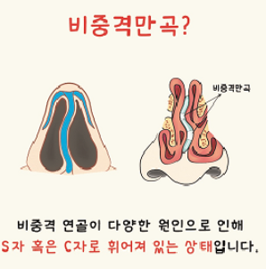 양쪽 코를 막아주는 벽인 비중막이 휘어져있는 비중격만곡