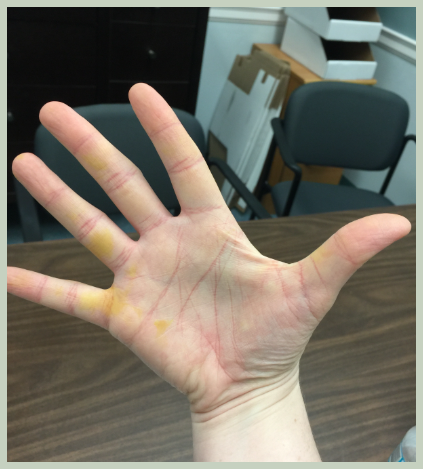 손바닥이 노란이유, 치료방법