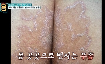 퍼지는무좀
