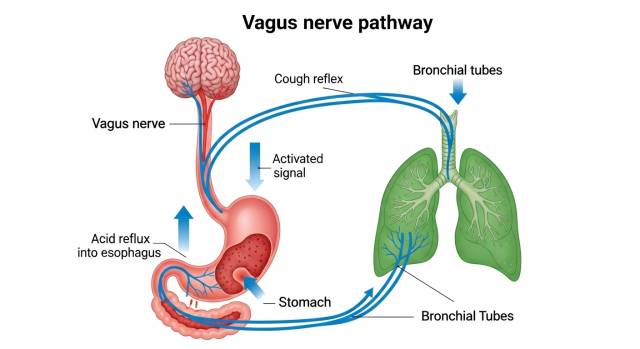 【IMG8 — 위산이 미주신경을 자극해 기침을 유발하는 신경 기전 의학 일러스트 이미지】