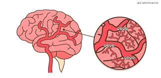 모야모야병 유전 증상 원인 치료 수술