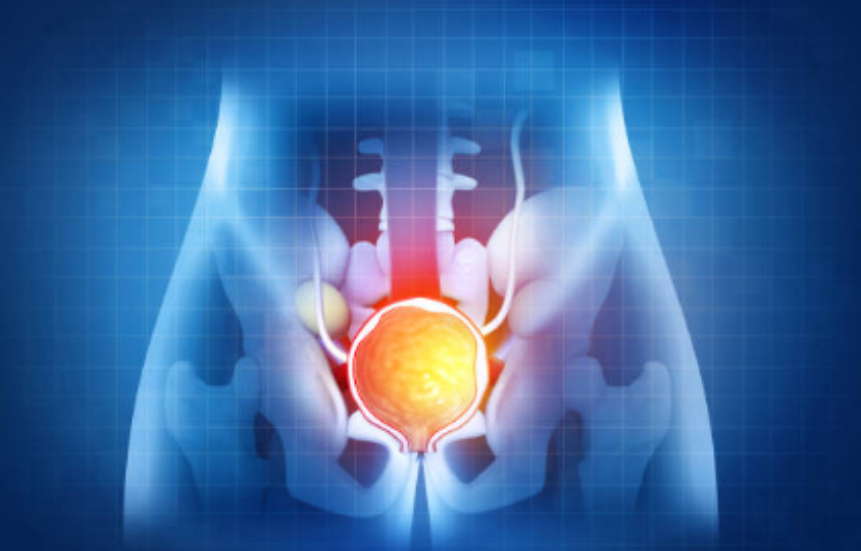 전립선 비대증이란