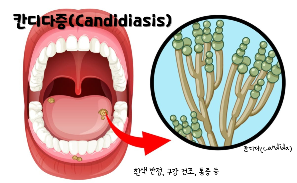 칸디다증(Candidiasis)
칸디다(Candida)
칸디다증 주요 증상 : 흰색 반점, 구강 건조, 통증 등