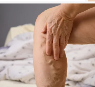 하지 정맥류 증상