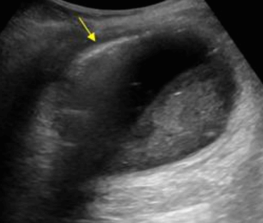 기종성 담낭염 (Emphysematous cholecystitis)