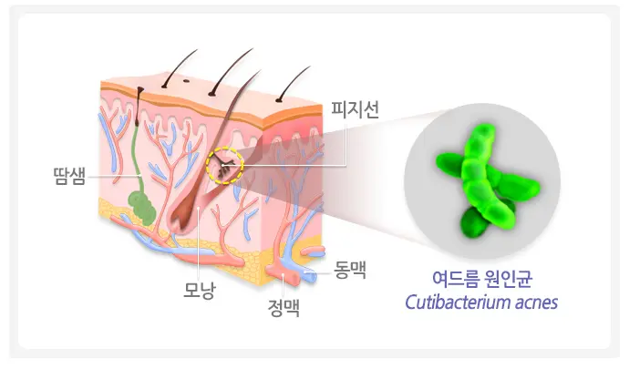 여드름 질병을 유발하는 세균 사진