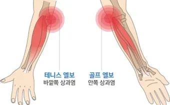 팔꿈치 통증 원인 6가지증상운동법예방법치료법까지_5