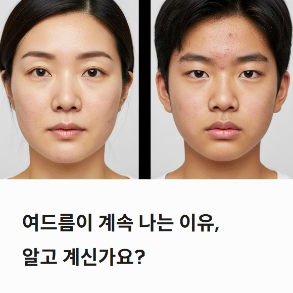 여드름 계속 나는 이유