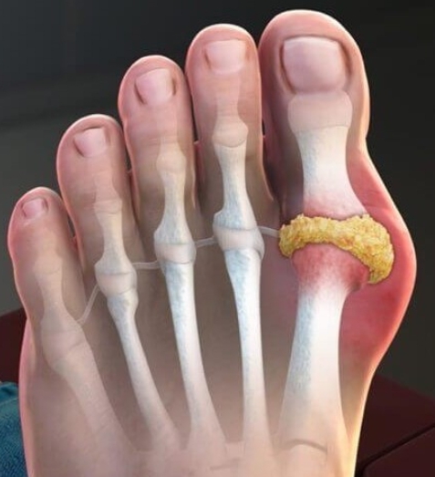 통풍발작 응급 대처 치료 방법 - 소염진통제 복용