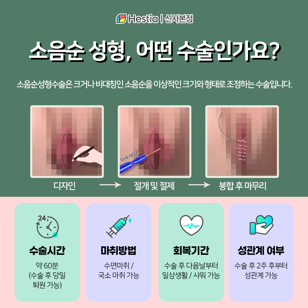 소음순성형수술, 어떤 수술일까?