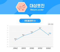 대상포진 초기증상