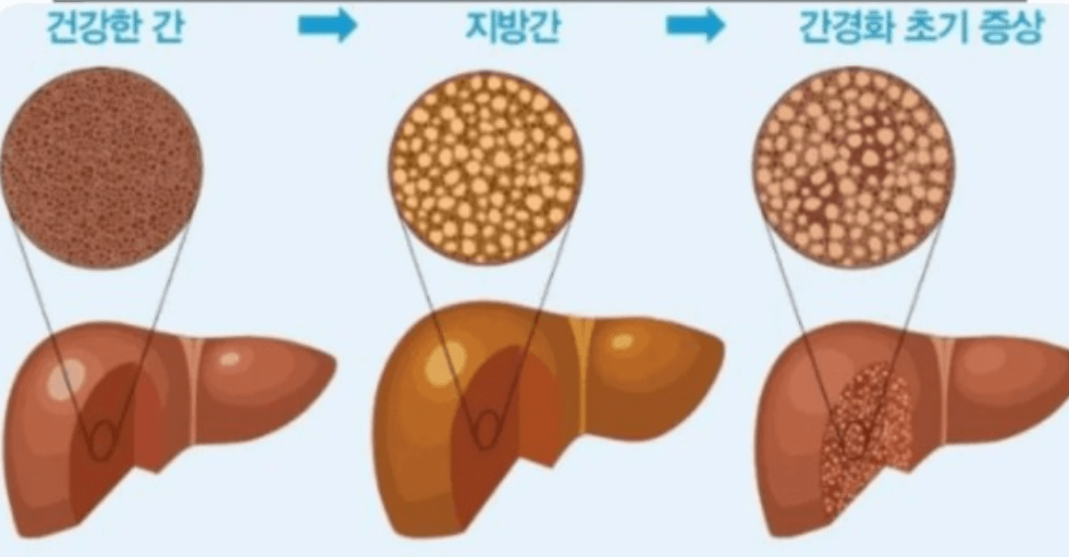 지방간 증상