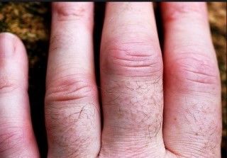 류마티스 관절염 초기증상